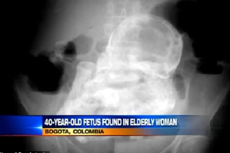 Döbbenet! 40 éves magzatot találtak a 82 éves asszony hasüregében