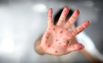 Kanyarójárvány van Belgrádban!